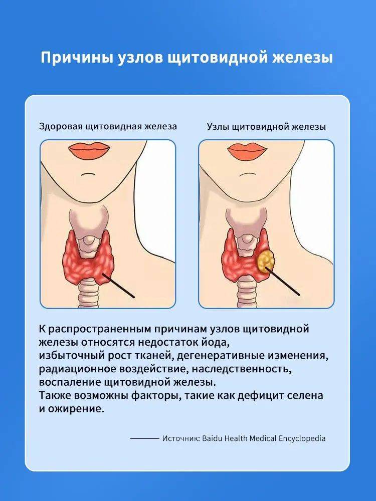 Thyroid therapeutic agent 30 g topical formula #4