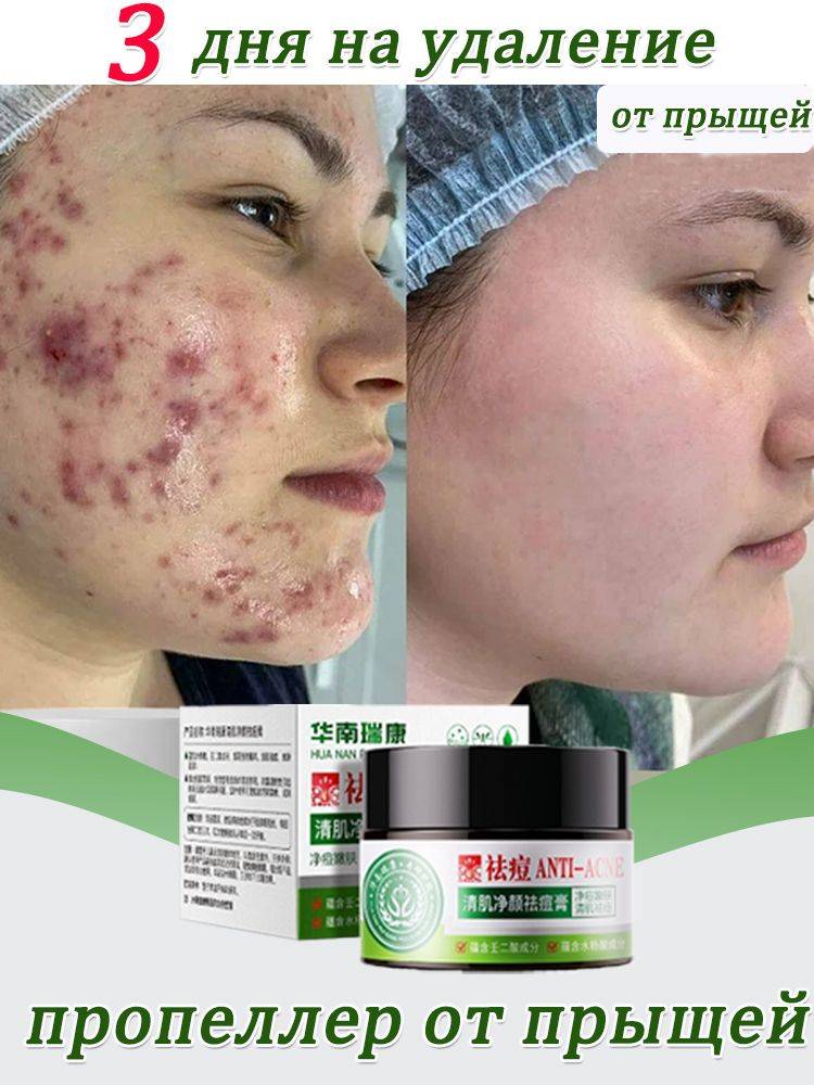 Acne Blackhead Skin Care Cream 30 g