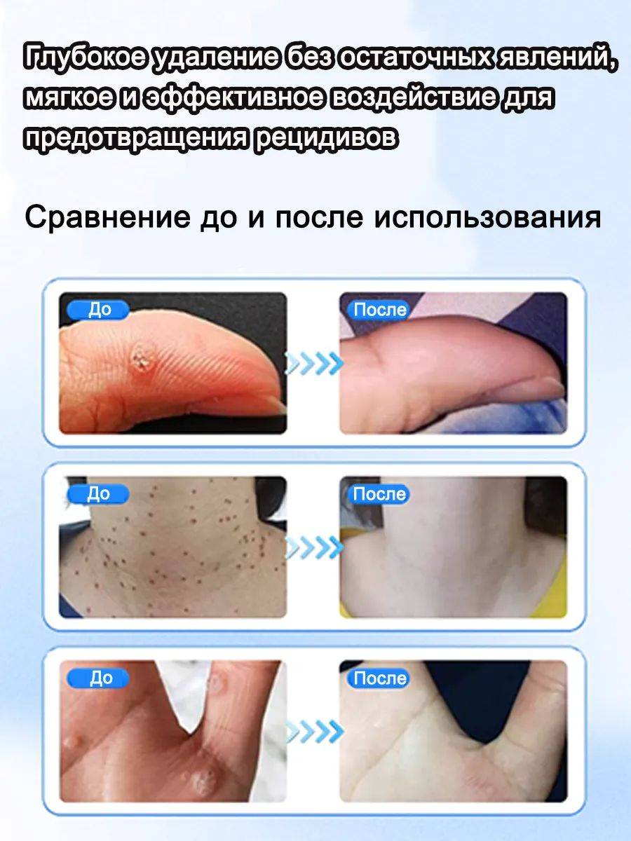 Collomak Wart and Papilloma Remover Cream – Painless, Fast-Acting Skin Treatment, 20ml #7