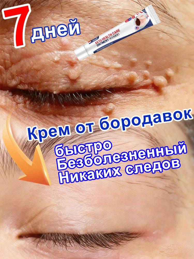 Wart and Papilloma Ointment Cream 20 ml