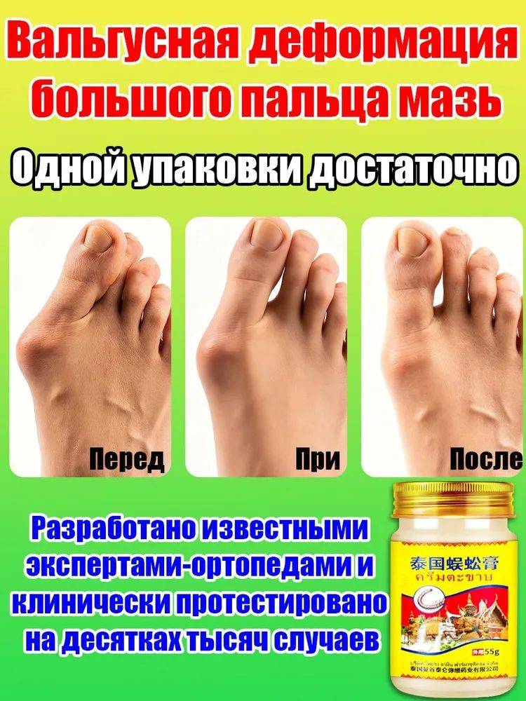 Hallux Valgus Correcting Cream, 125 ml, 1 Pack