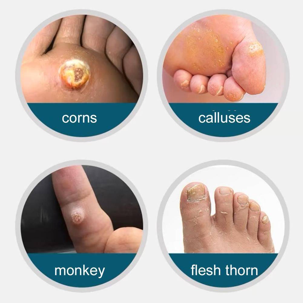 Foot Corn, Callus, and Plantar Wart Treatment #10
