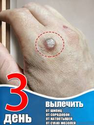 Wart Removal Cream for Skin Growths and Corns, 20 ml #1