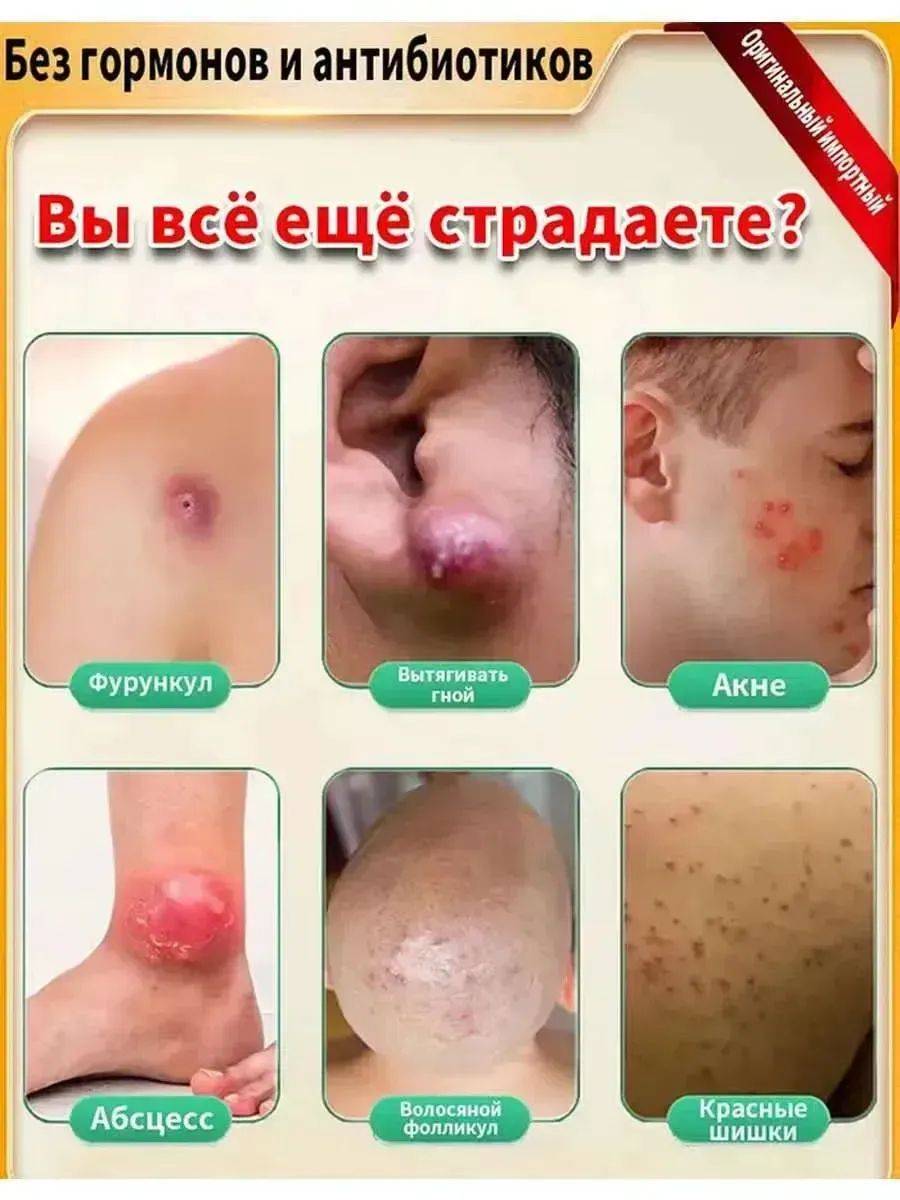 Chinese Miracle Ointment for Boils, Acne, and Abscesses, 20g #6