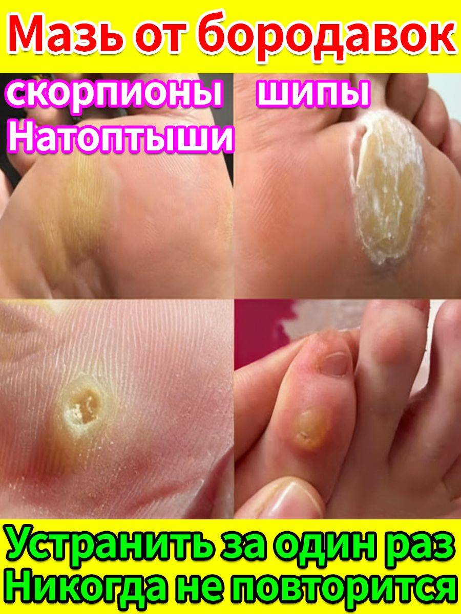 Celandine Foot Cream for Warts and Calluses 20 ml