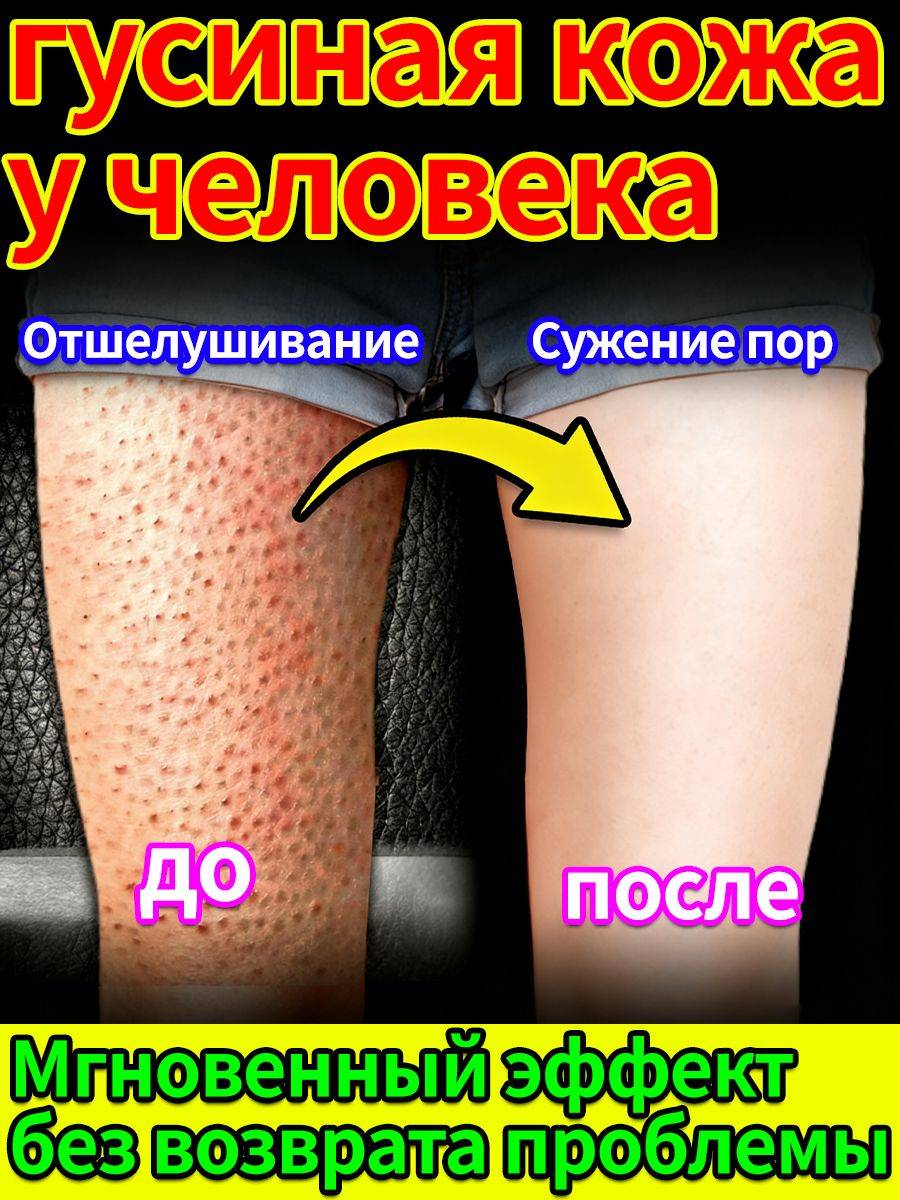 Intensive Leg Cream for Keratosis Pilaris, 20 ml