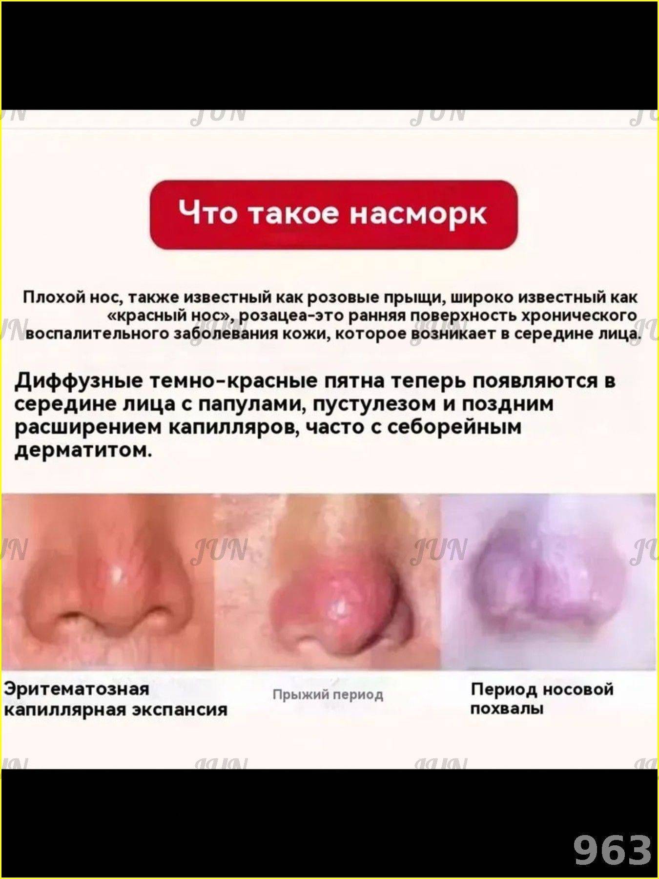 Therapeutic Cream for Rosacea, Dilated Capillaries, Oily Skin & Nasal Swelling - 30g #10