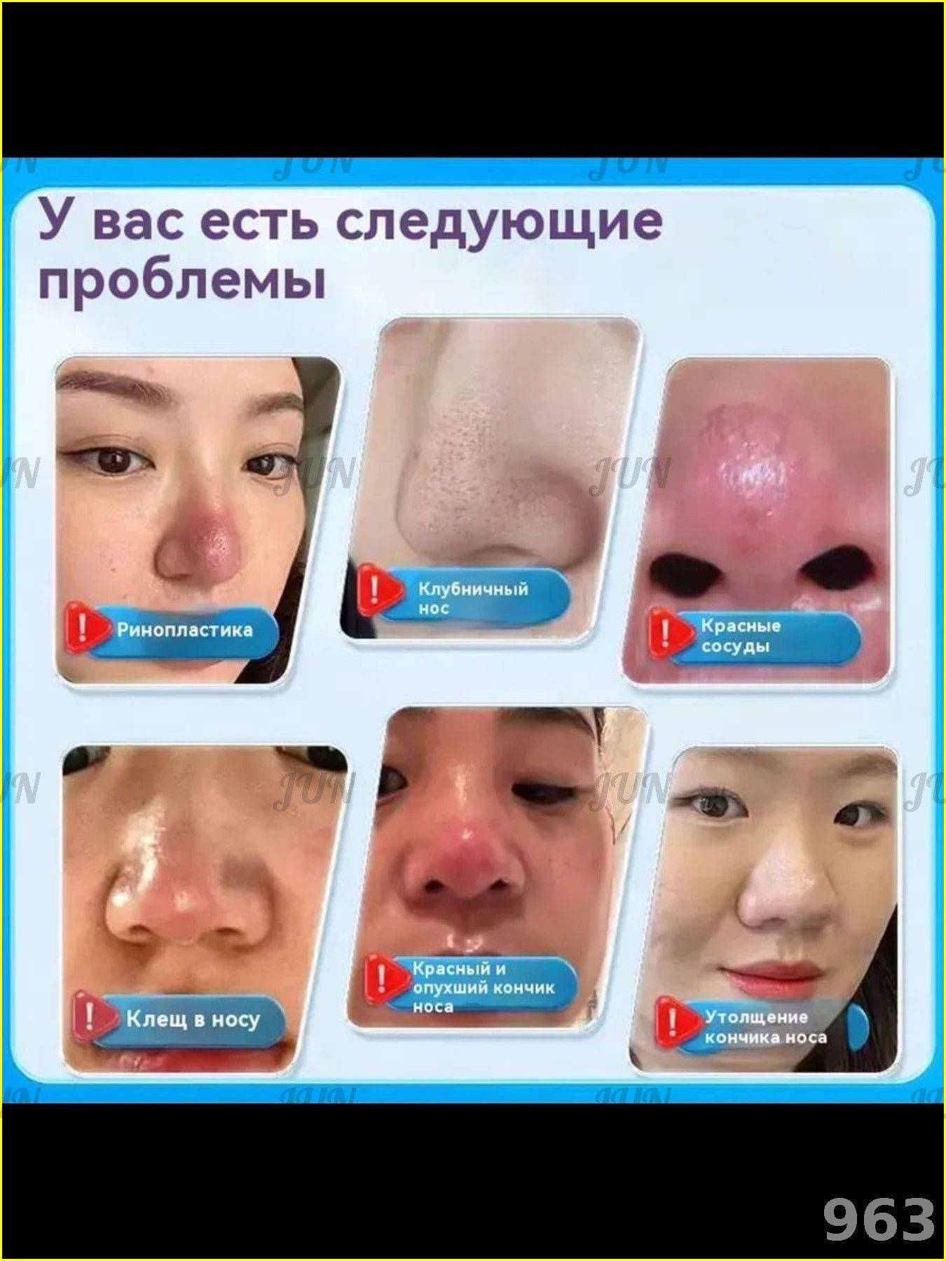 Therapeutic Cream for Rosacea, Dilated Capillaries, Oily Skin & Nasal Swelling - 30g #5