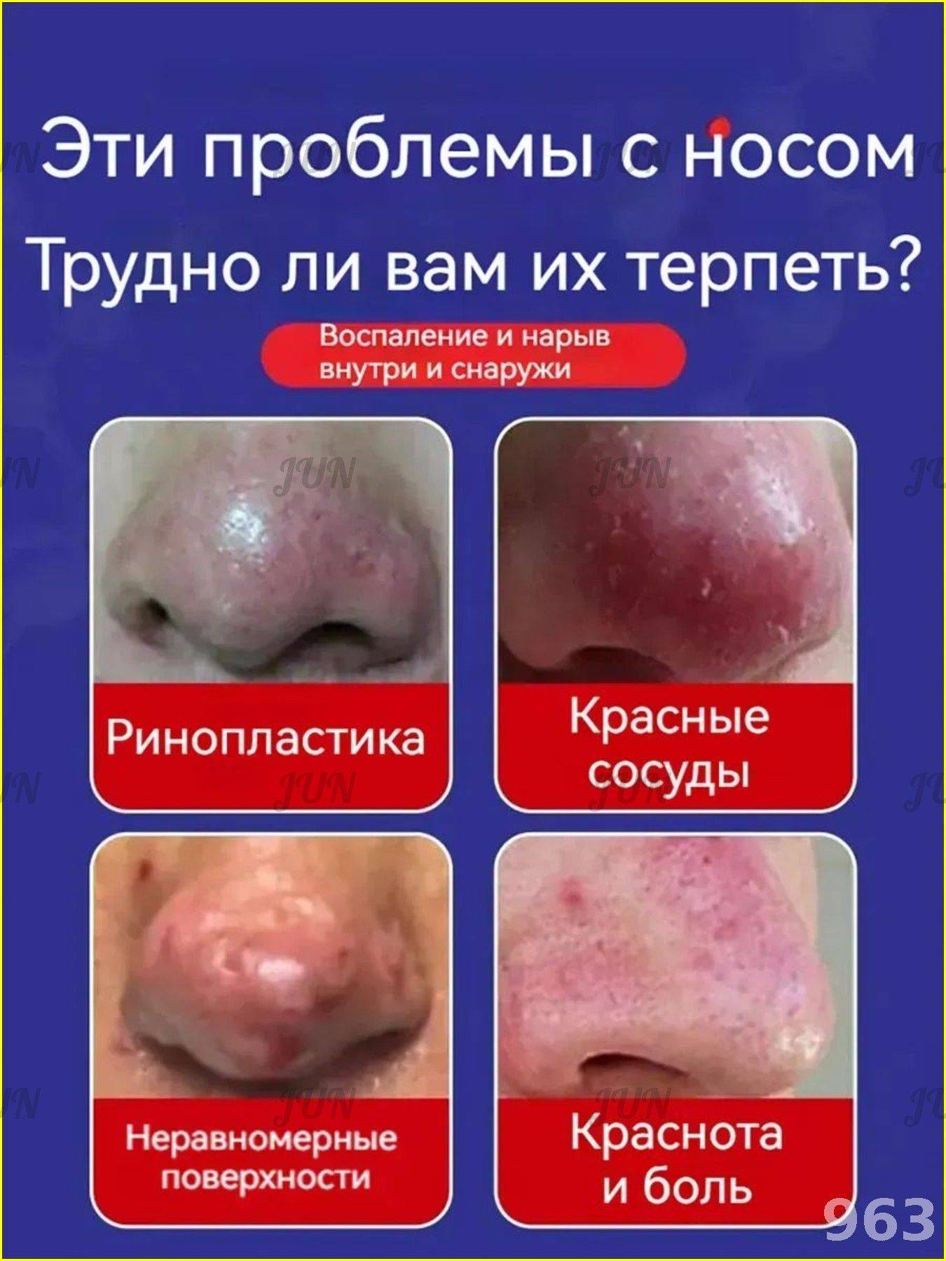 Therapeutic Cream for Rosacea, Dilated Capillaries, Oily Skin & Nasal Swelling - 30g #3