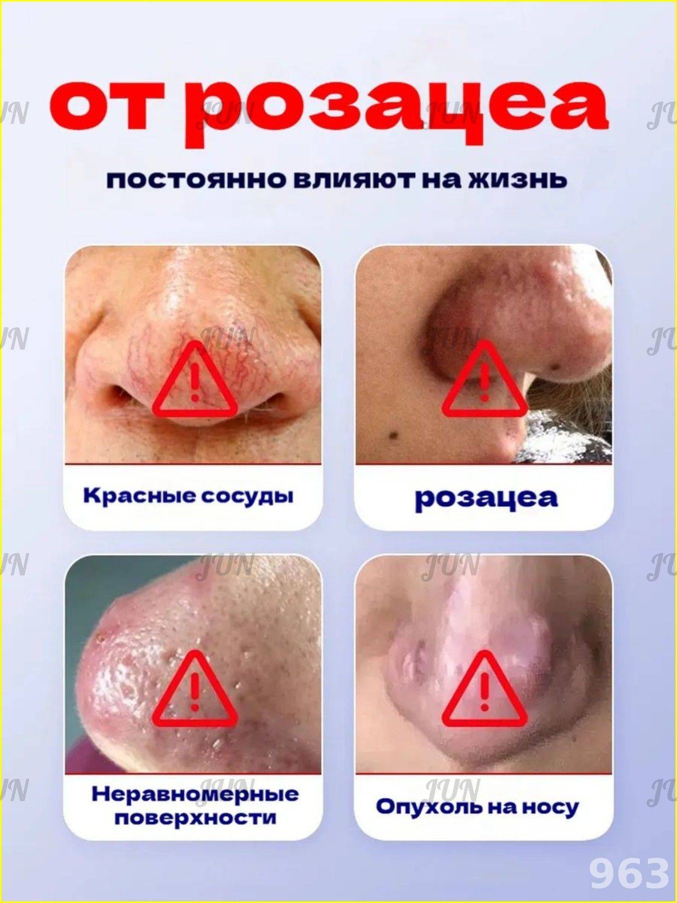 Therapeutic Cream for Rosacea, Dilated Capillaries, Oily Skin & Nasal Swelling - 30g #4