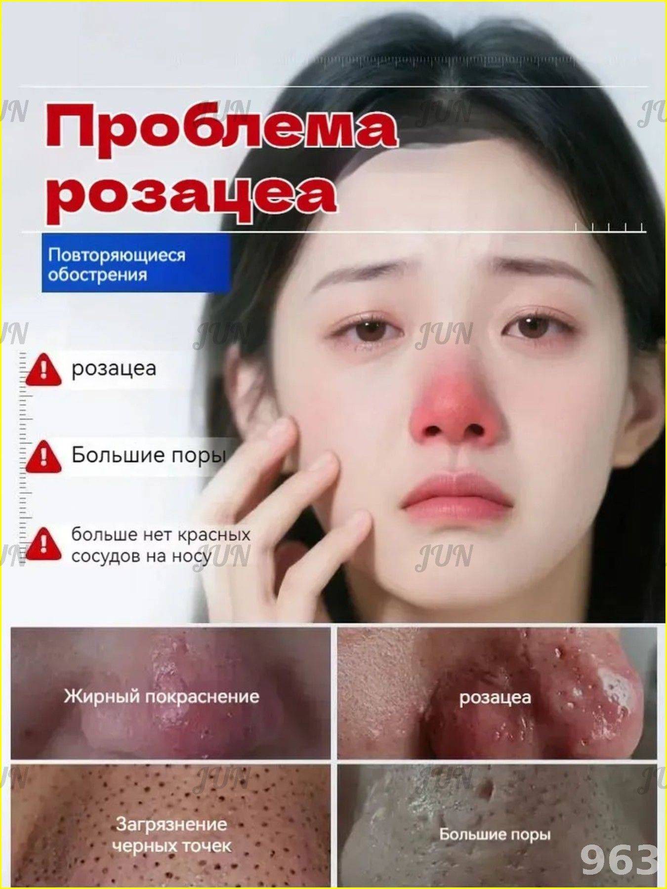 Therapeutic Cream for Rosacea, Dilated Capillaries, Oily Skin & Nasal Swelling - 30g #11