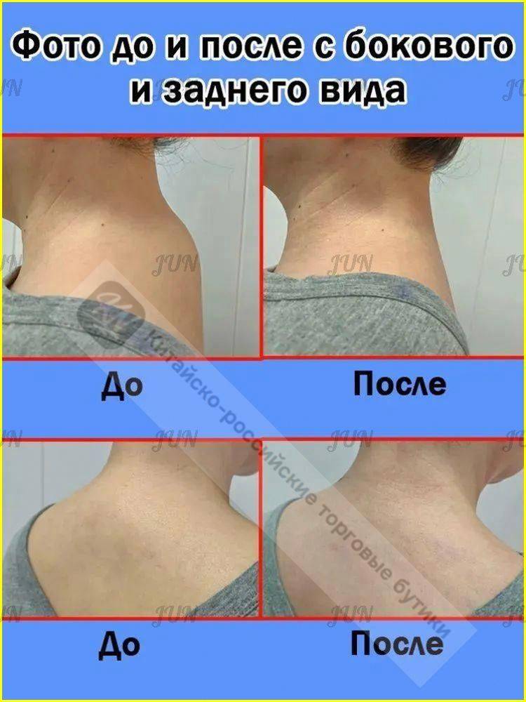 Therapeutic Patches for Cervical Spondylosis, Lumbar Spondylosis, Arthralgia, and Muscle Pain - 10 Count #4