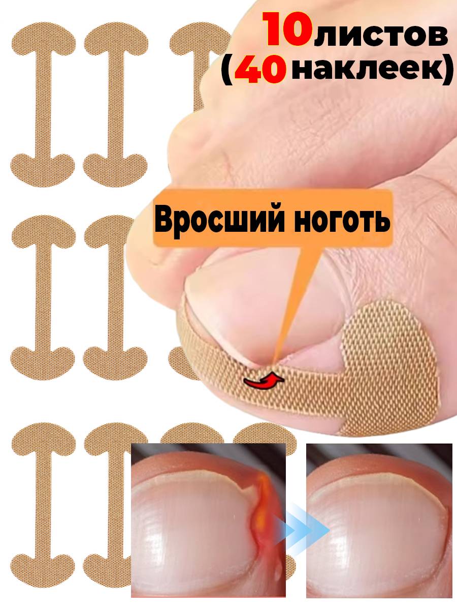 Ingrown Toenail Correction Patch Strips Patches