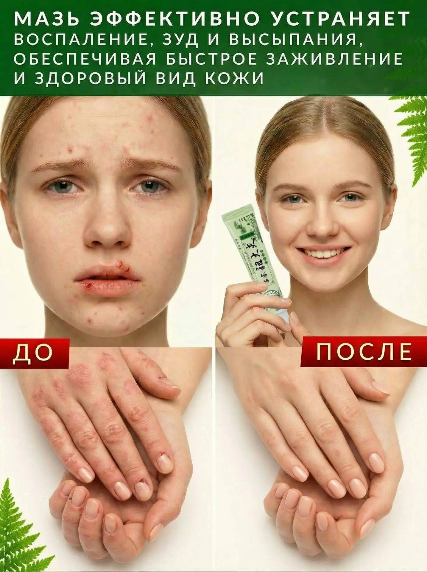 Sumifun Zudaifu 15 ml Cream for Dermatitis, Psoriasis, and Antifungal Skin Care #4