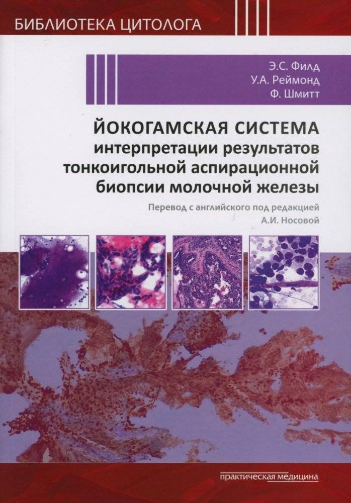 Йокогамская система интерпретации результатов тонкоигольной аспирационной биопсии молочной железы | Yokohama System for Interpreting Breast Fine Needle Aspiration Biopsy Results