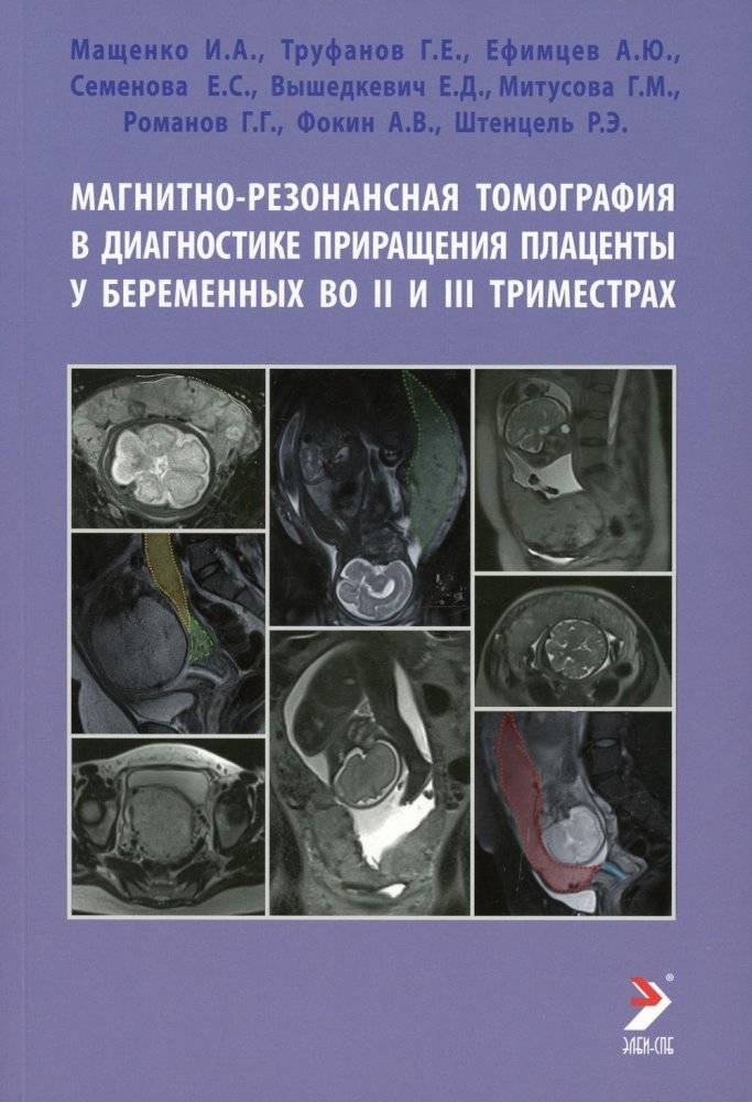 Магнитно-резонансная томография в диагностике приращения плаценты у беременных во II и III триместрах. Учебное пособие | Magnetic Resonance Imaging in Diagnosing Placental Increta in Pregnant Women in the 2nd and 3rd Trimesters: A Study Guide
